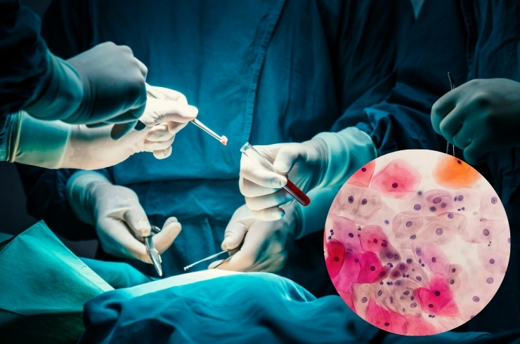 Biopsy