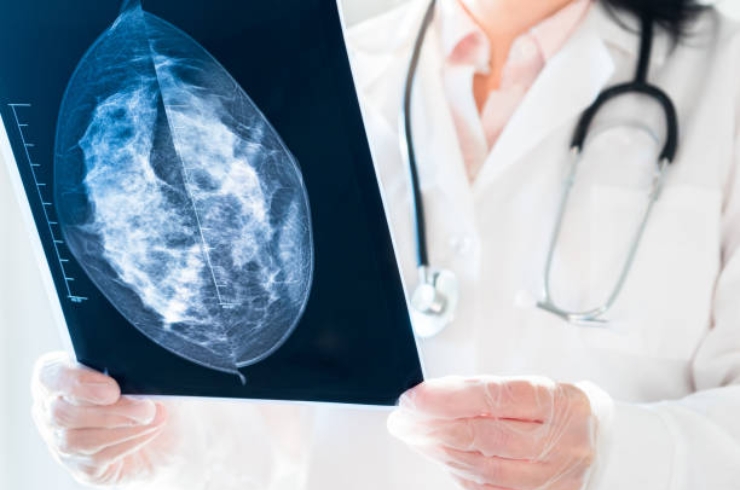 Mammography